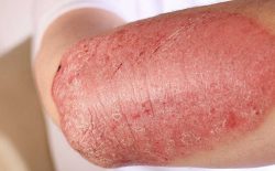 Bệnh vẩy nến á sừng rất phổ biến ở nước ta, gây ngứa và khó chịu cho người bệnh