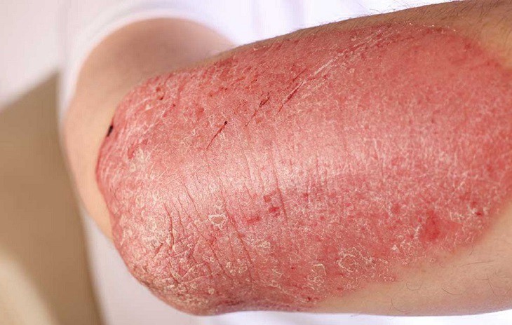 Bệnh vẩy nến á sừng rất phổ biến ở nước ta, gây ngứa và khó chịu cho người bệnh