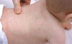 Bé nổi mẩn đỏ là dấu hiệu của bệnh gì? Biện pháp chữa trị hiệu quả