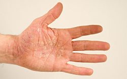 Bệnh á sừng rất phổ biến và có thể gặp ở bất cứ ai