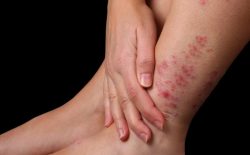 Bệnh á sừng có lây không