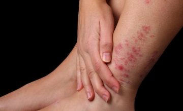 Bệnh á sừng có lây không