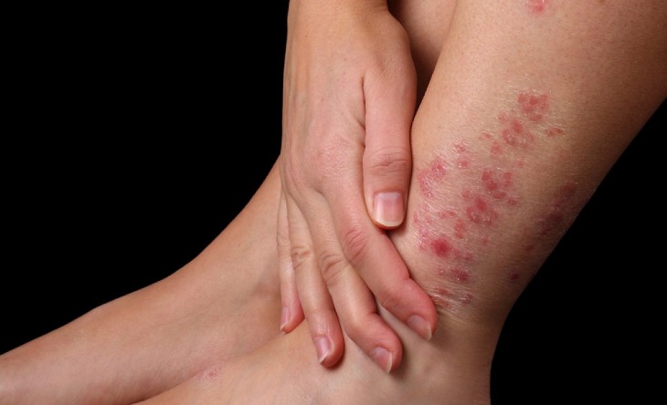 Bệnh á sừng có lây không
