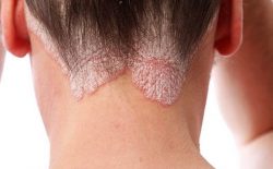 Bệnh vảy nến có lây không