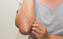 Bệnh vảy nến có tự khỏi không