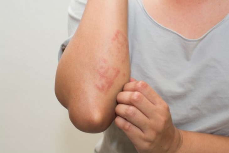 Bệnh vảy nến có tự khỏi không
