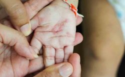 Bệnh vảy nến ở trẻ sơ sinh