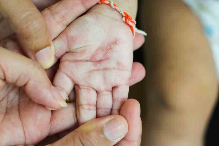 Bệnh vảy nến ở trẻ sơ sinh