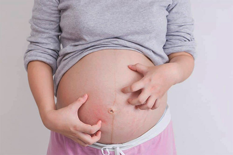 Nổi mề đay khi mang thai – Mẹ bầu cần hiểu đúng, ghi nhớ cách chữa an toàn