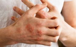 Cách chữa bệnh á sừng bằng cách nào?