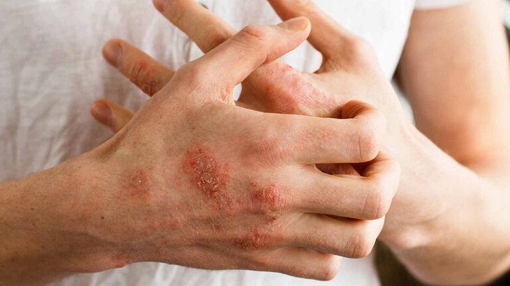 Cách chữa bệnh á sừng bằng cách nào?
