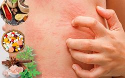 Cách chữa nổi mẩn ngứa khắp người