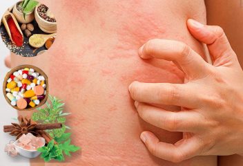 Cách chữa nổi mẩn ngứa khắp người