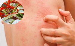 Lá đơn đỏ là bài thuốc chữa mề đay hiệu quả được truyền lại từ nhiều đời nay