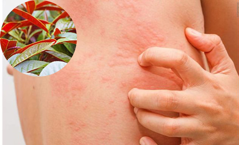 Lá đơn đỏ là bài thuốc chữa mề đay hiệu quả được truyền lại từ nhiều đời nay