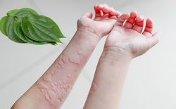 Chữa mề đay bằng lá trầu không