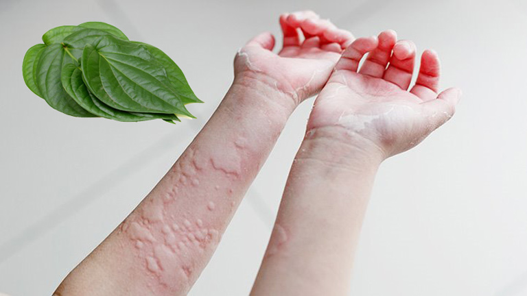 Chữa mề đay bằng lá trầu không