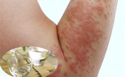 Điều trị mề đay bằng rượu cần tham khảo ý kiến bác sĩ chuyên môn