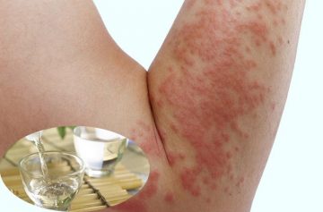Điều trị mề đay bằng rượu cần tham khảo ý kiến bác sĩ chuyên môn