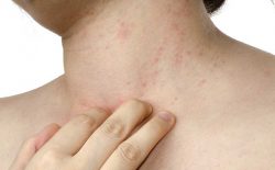 Mề đay cấp tính và cách chữa