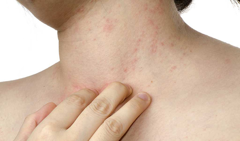 Mề đay cấp tính và cách chữa