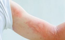 Da nổi mẩn đỏ ngứa nguy hiểm như thế nào? Cách điều trị dứt điểm