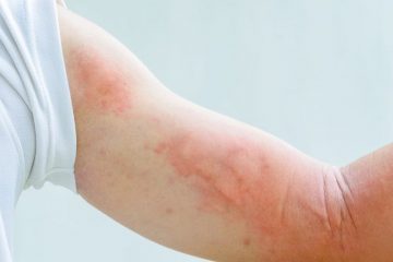 Da nổi mẩn đỏ ngứa nguy hiểm như thế nào? Cách điều trị dứt điểm