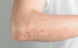 Nổi mẩn đỏ không ngứa: Cách điều trị hiệu quả nhanh chóng
