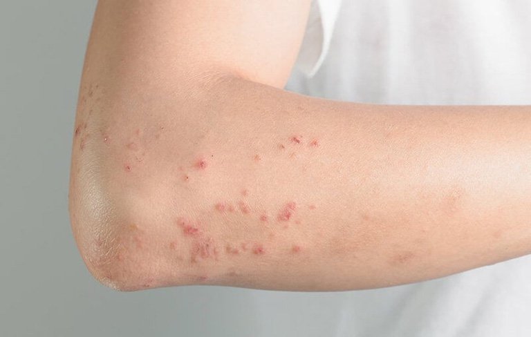 Nổi mẩn đỏ không ngứa: Cách điều trị hiệu quả nhanh chóng