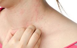 Nổi mẩn đỏ ngứa như muỗi đốt là biểu hiện bệnh gì? Và cách chữa