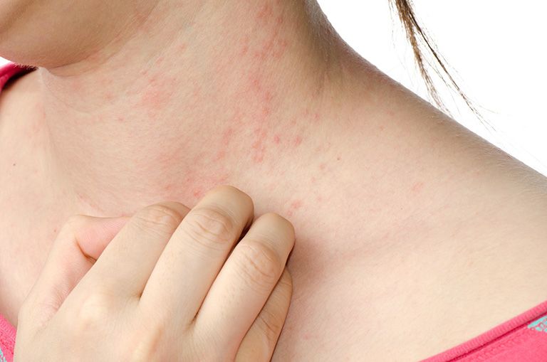 Nổi mẩn đỏ ngứa như muỗi đốt là biểu hiện bệnh gì? Và cách chữa