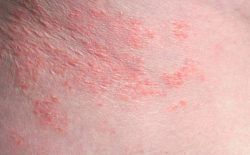 Nổi Mẩn Đỏ Ở Háng Không Ngứa: Dấu Hiệu Gây Bệnh Và Cách Chữa Trị