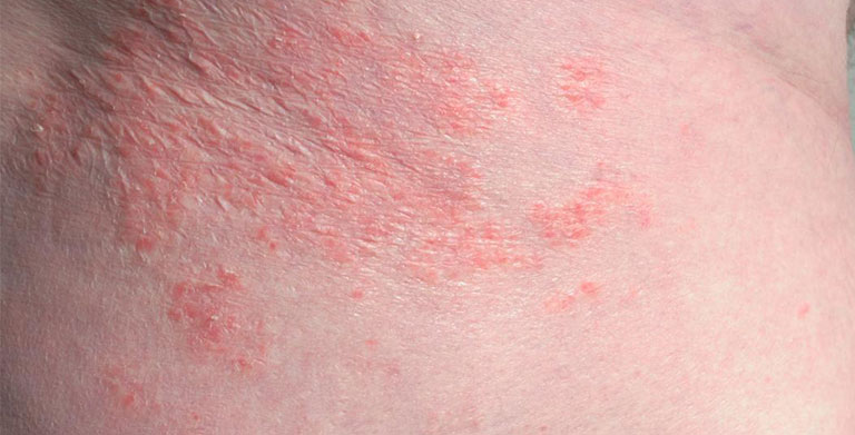 Nổi Mẩn Đỏ Ở Háng Không Ngứa: Dấu Hiệu Gây Bệnh Và Cách Chữa Trị