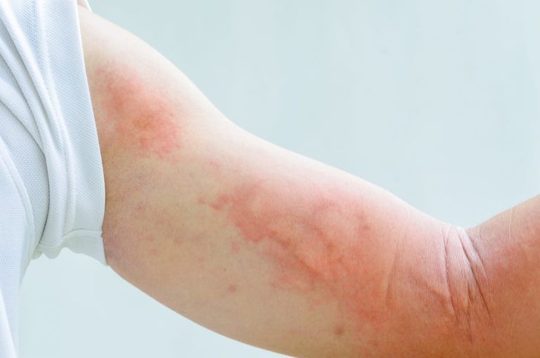 Da nổi mẩn đỏ ngứa nguy hiểm như thế nào? Cách điều trị dứt điểm
