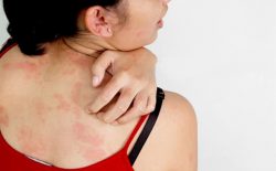 Nổi mề đay kiêng gió không