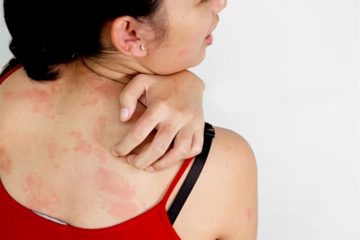 Nổi mề đay kiêng gió không