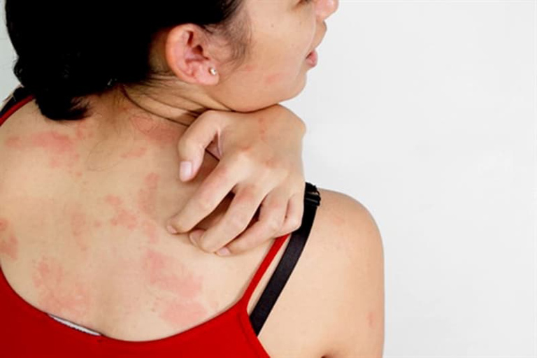 Nổi mề đay kiêng gió không