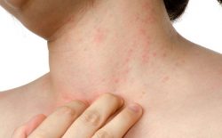 Nổi mề đay ở cổ: Nguyên nhân, dấu hiệu, chữa trị tận gốc