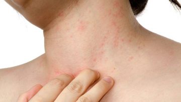 Nổi mề đay ở cổ: Nguyên nhân, dấu hiệu, chữa trị tận gốc