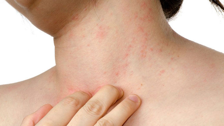 Nổi mề đay ở cổ: Nguyên nhân, dấu hiệu, chữa trị tận gốc