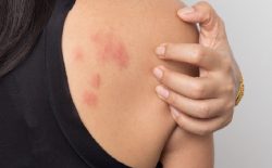 Nổi mề đay sau sinh