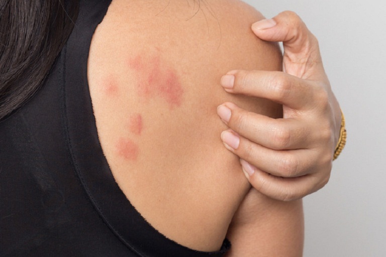 Nổi mề đay sau sinh