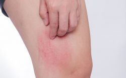 Nổi mè đay toàn thân gây cảm giác ngứa ngáy, bứt rứt cho người bệnh