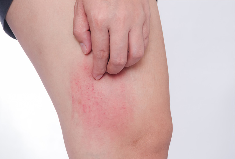 Nổi mè đay toàn thân gây cảm giác ngứa ngáy, bứt rứt cho người bệnh