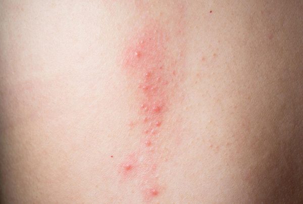 phát ban đỏ không sốt