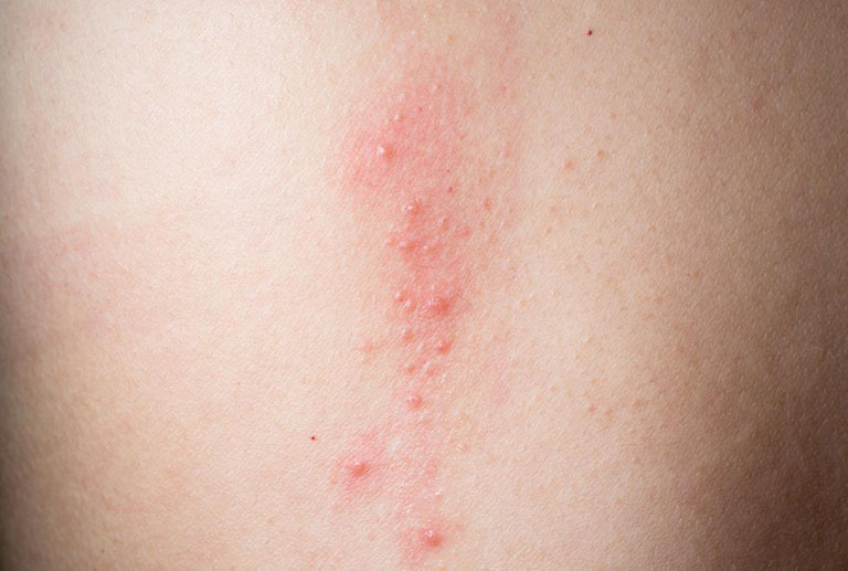 phát ban đỏ không sốt