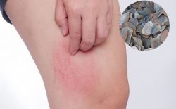 Vảy trút được xem là dược liệu quý chữa mề đay hiệu quả