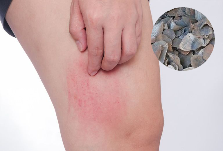 Vảy trút được xem là dược liệu quý chữa mề đay hiệu quả