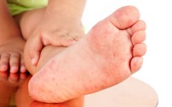 Trẻ bị nổi mề đay vẫn có thể tắm rửa bình thường