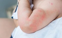Trẻ bị nổi mề đay tắm lá gì cho an toàn và hiệu quả
